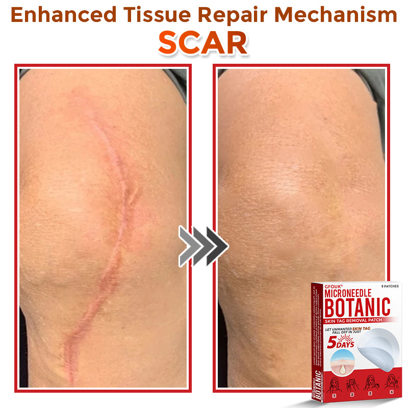GFOUK® MicroNeedle Botanic Skin Tag Removal Patch 🇺🇸
