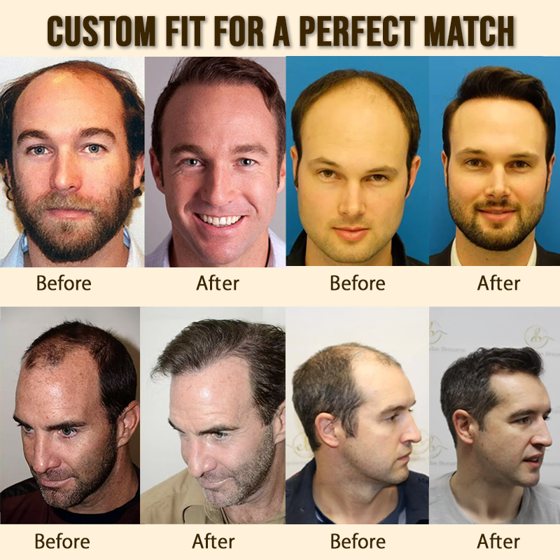 Sugoola® GhostLine Invisible Secret Frontal Hairline System 🇺🇸 100% Natural, Reliable for High Forehead
