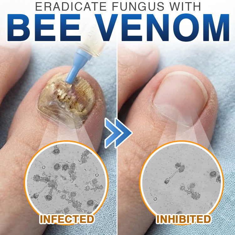🇺🇸 CareBreeze® Fungi Free Bee Venom Nail Treatment 🥼🩺