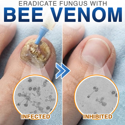 🇺🇸 CareBreeze® Fungi Free Bee Venom Nail Treatment 👨‍⚕️✨