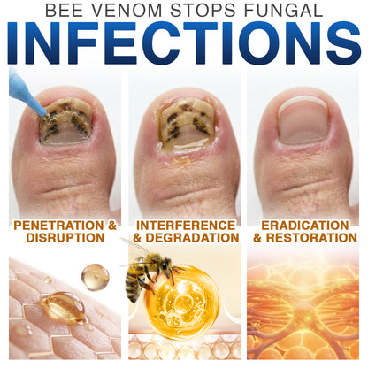 🇺🇸 CareBreeze® Fungi Free Bee Venom Nail Treatment 🥼🩺