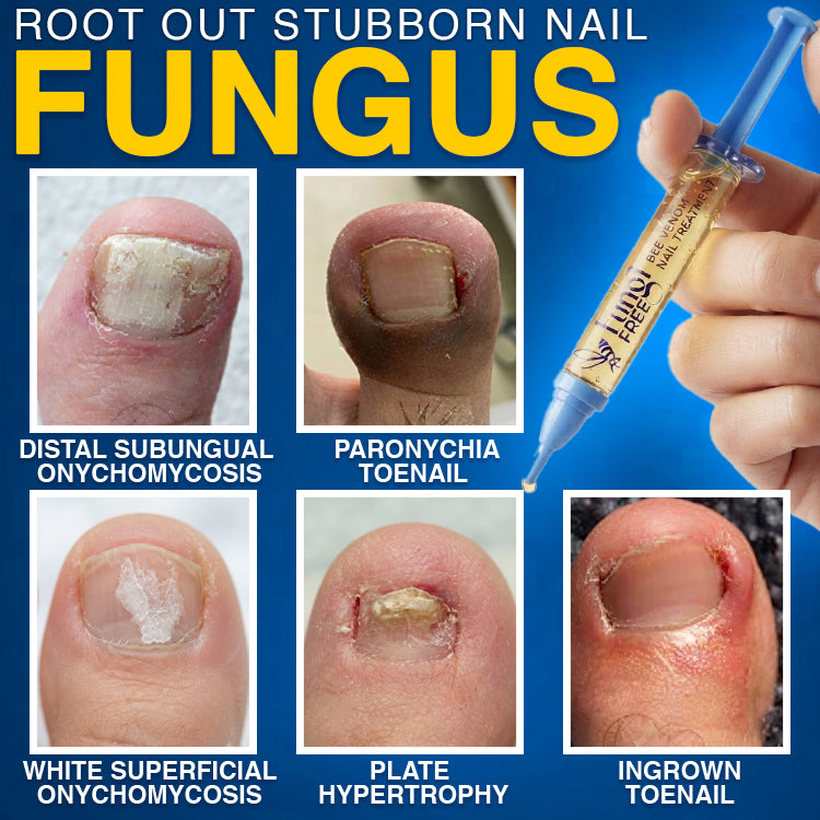 🇺🇸 CareBreeze® Fungi Free Bee Venom Nail Treatment 🐝✨