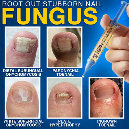 🇺🇸 CareBreeze® Fungi Free Bee Venom Nail Treatment 🐝✨