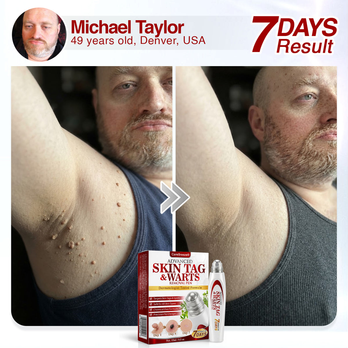 🇺🇸 CareBreeze® Herbal Skin Tag & Wart Removal Roller 🧑🏼‍⚕️