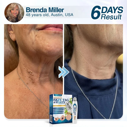 🇺🇸 CareBreeze® Advanced Skin Tag & Wart Removal Roller 🏆