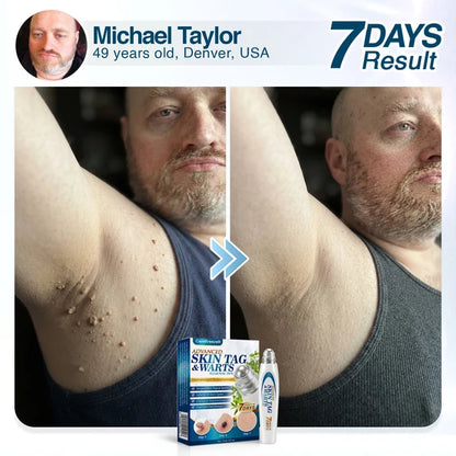 🇺🇸 CareBreeze® Advanced Skin Tag & Wart Removal Roller 🏆