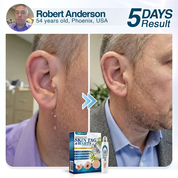 🇺🇸 CareBreeze® Advanced Skin Tag & Wart Removal Roller 🏆