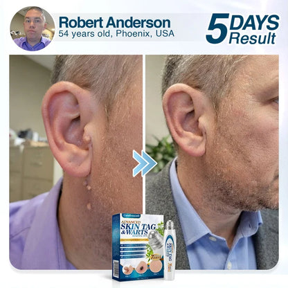 🇺🇸 CareBreeze® Advanced Skin Tag & Wart Removal Roller 🏆