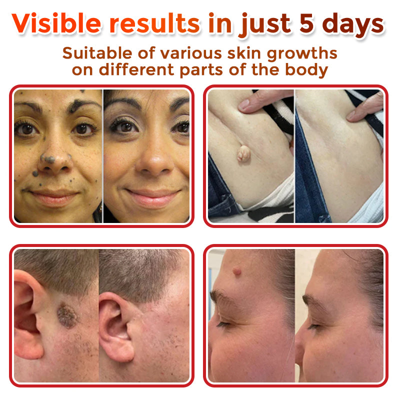 🇺🇸👩‍⚕️ GFOUK® MicroNeedle Botanic Skin Tag Removal Patch 🇺🇸 Made in the USA