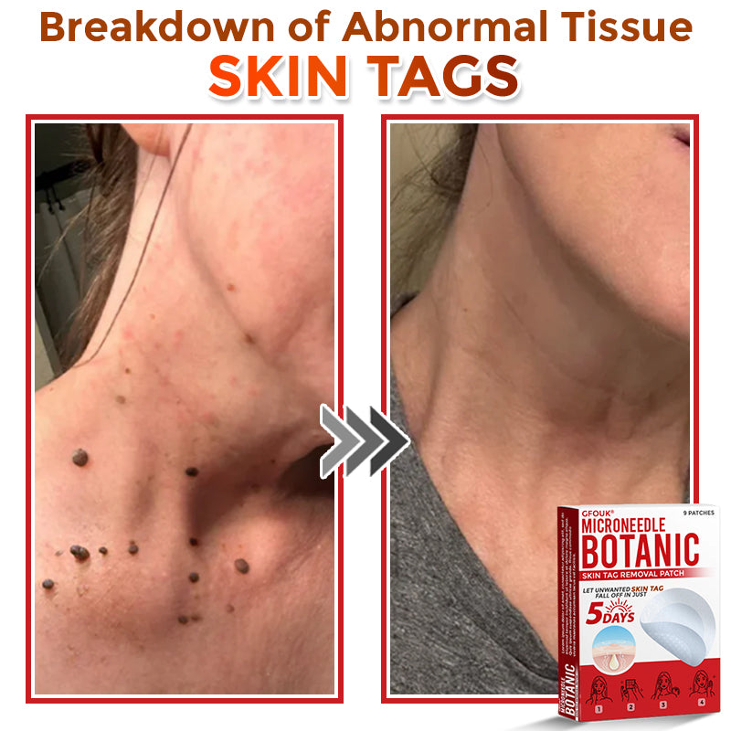 🇺🇸👩‍⚕️ GFOUK® MicroNeedle Botanic Skin Tag Removal Patch 🇺🇸 Made in the USA