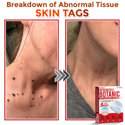 🇺🇸👩‍⚕️ GFOUK® MicroNeedle Botanic Skin Tag Removal Patch 🇺🇸 Made in the USA
