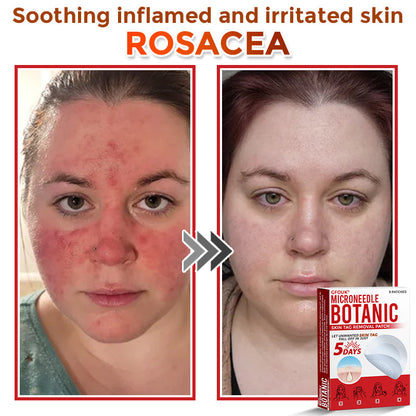 GFOUK® MicroNeedle Botanic Skin Tag Removal Patch 🇺🇸