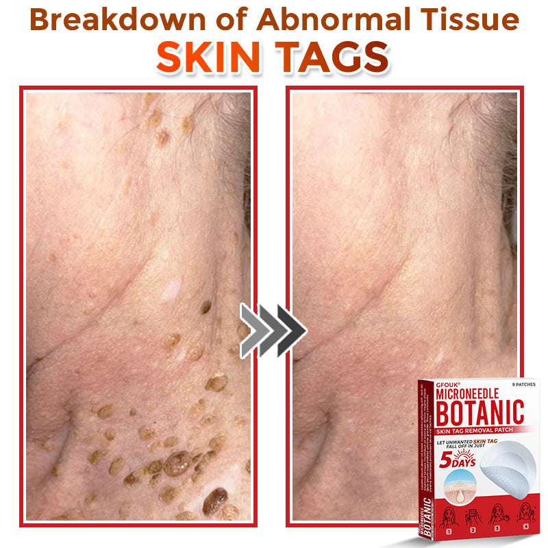 🇺🇸👩‍⚕️ GFOUK® MicroNeedle Botanic Skin Tag Removal Patch 🇺🇸 Made in the USA
