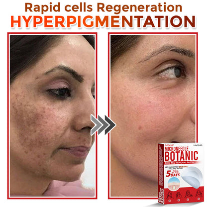 GFOUK® MicroNeedle Botanic Skin Tag Removal Patch 🇺🇸
