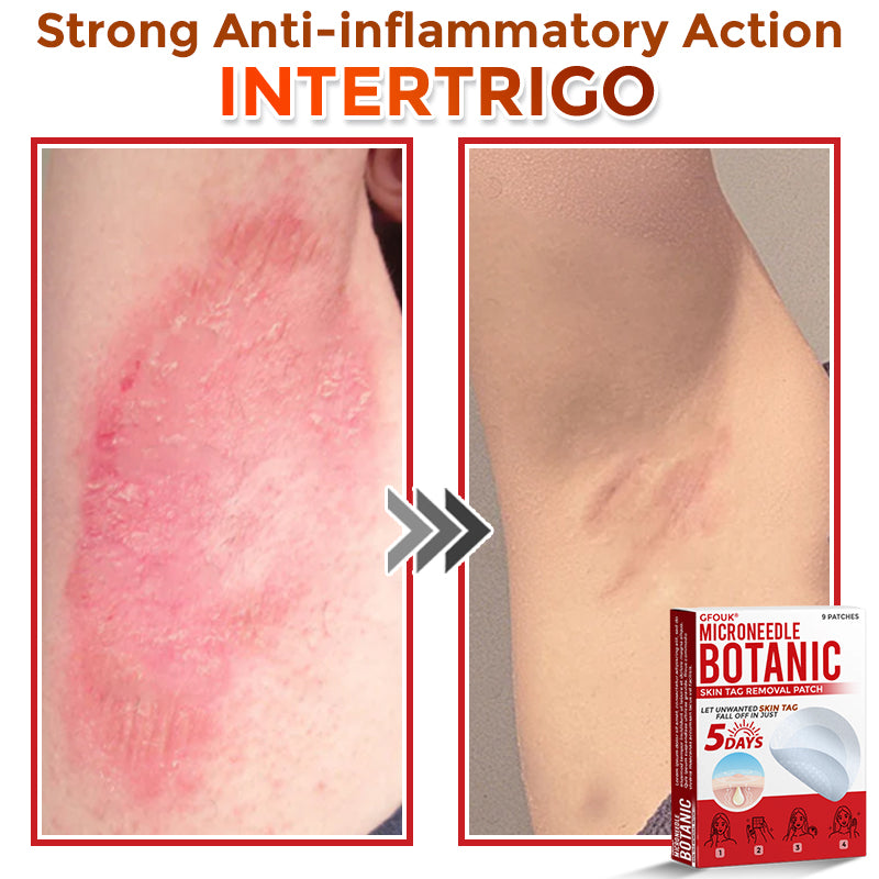 GFOUK® MicroNeedle Botanic Skin Tag Removal Patch 🇺🇸