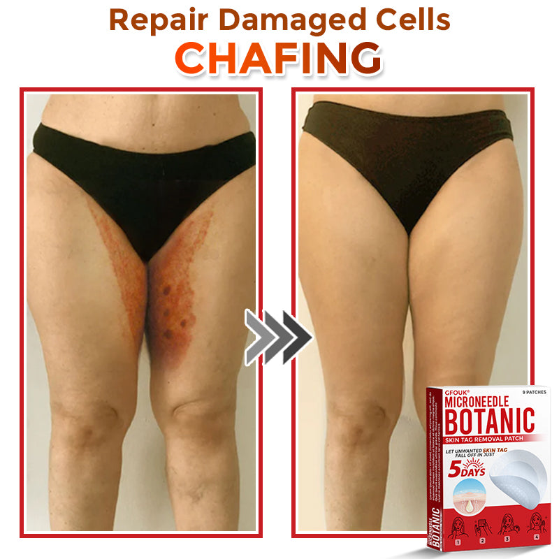 GFOUK® MicroNeedle Botanic Skin Tag Removal Patch 🇺🇸