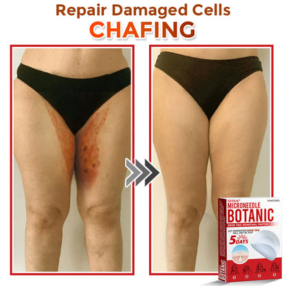 GFOUK® MicroNeedle Botanic Skin Tag Removal Patch 🇺🇸
