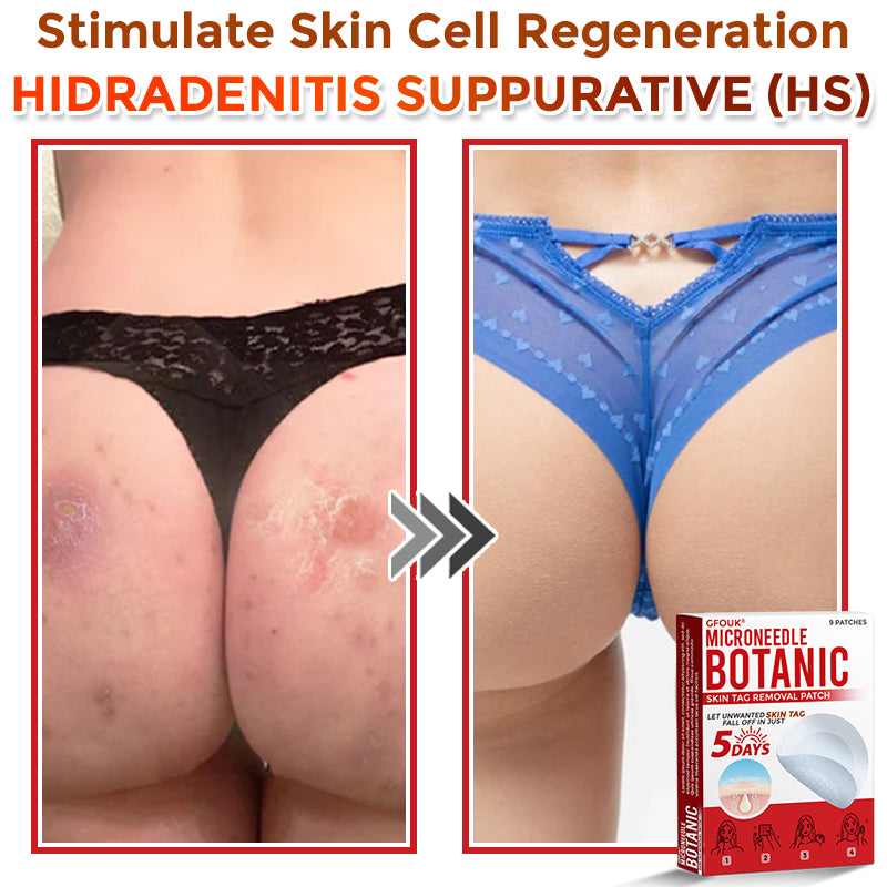 GFOUK® MicroNeedle Botanic Skin Tag Removal Patch 🇺🇸