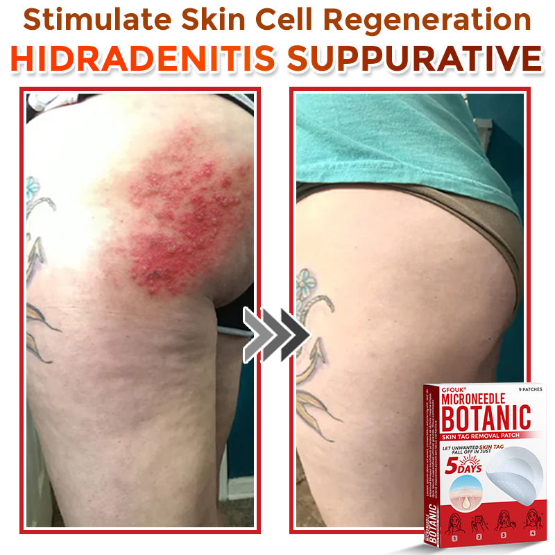 GFOUK® MicroNeedle Botanic Skin Tag Removal Patch 🇺🇸