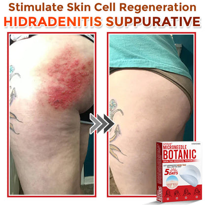 GFOUK® MicroNeedle Botanic Skin Tag Removal Patch 🇺🇸