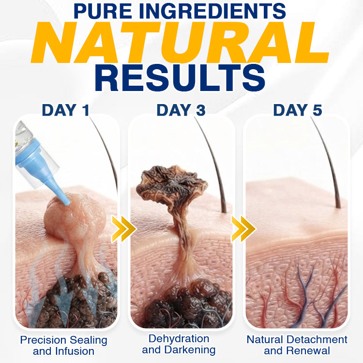 🇺🇸 CareBreeze® Skin Tag Removal Precision Gel 🥼