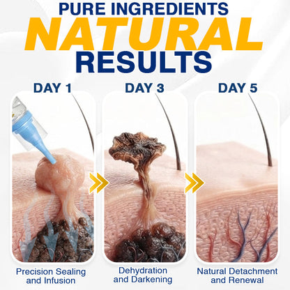 🇺🇸 CareBreeze® Skin Tag Removal Precision Gel 🥼