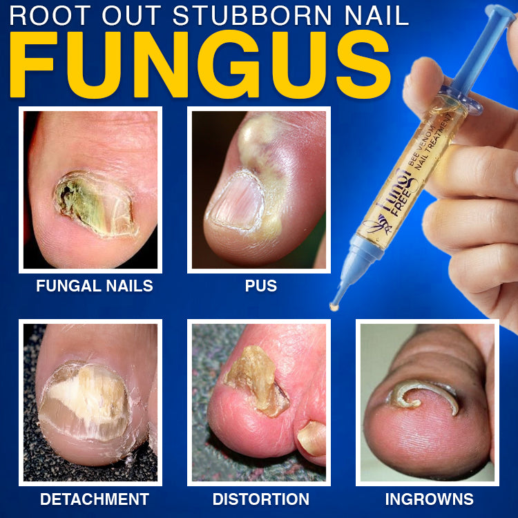 🇺🇸 CareBreeze® Fungi Free Bee Venom Nail Treatment 🥼🩺