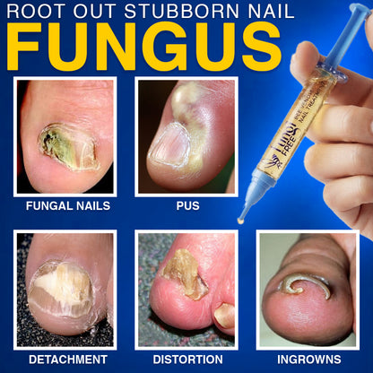 🇺🇸 CareBreeze® Fungi Free Bee Venom Nail Treatment 🥼🩺