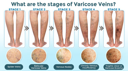 GFOUK® VenaRestore MicroNeedle Vein Repair Patch 🇺🇸